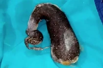 Chuyện lạ độc: Bé gái ăn cả cân tóc, lý do nhện hung dữ...