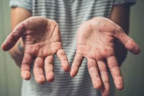 Virus đậu mùa khỉ có thể tồn tại trên các bề mặt