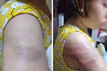 Phụ huynh lên mạng tố giáo viên đánh học sinh bầm tay vì viết bài chậm