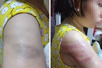 Phụ huynh lên mạng tố giáo viên đánh học sinh bầm tay vì viết bài chậm