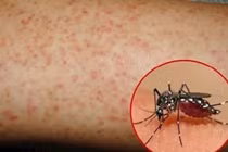 Những triệu chứng thường gặp nhưng dễ gây nhầm lẫn với sốt xuất huyết