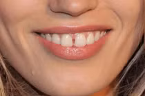 Nhìn tướng răng đoán ngay số phận giàu có hay nghèo hèn