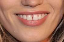 Nhìn tướng răng đoán ngay số phận giàu có hay nghèo hèn