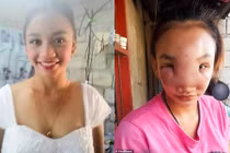 Nặn mụn mũi, cô gái mắc bệnh lạ người thân cũng nhận không ra