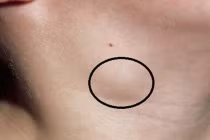 7 triệu chứng rõ mồn một của K tuyến giáp, nhiều người ở giai đoạn nặng