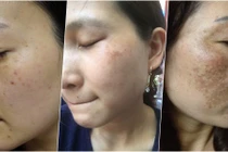 1 loại lá chuyên trị nám cực hiệu quả, tìm đâu cũng có 