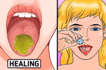 Ăn lẩu, nướng nhiều bị bỏng rát lưỡi và 10 cách chữa lành cấp tốc