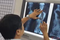 Căn bệnh khiến cột sống uốn cong như con rồng
