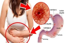 Đau dạ dày nên tránh tuyệt đối những thực phẩm này