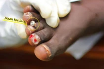 Sự khủng khiếp của loài bọ đẻ trứng lúc nhúc dưới da người