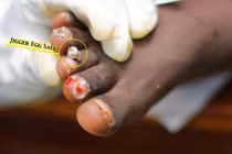 Sự khủng khiếp của loài bọ đẻ trứng lúc nhúc dưới da người