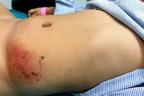 Con bỗng hoại tử vùng bụng do mẹ dán loại cao phổ biến trị mụn