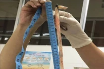 Bé gái sinh ra khỏe mạnh với 4 vòng dây rốn cuốn cổ