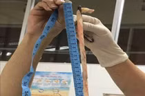 Bé gái sinh ra khỏe mạnh với 4 vòng dây rốn cuốn cổ