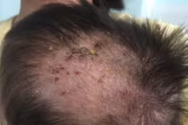 Trẻ bị chốc đầu liên tục - dấu hiệu cảnh báo bệnh hiếm gặp