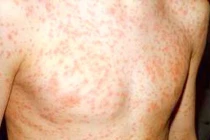 Cặp song sinh 11 tháng nguy kịch vì biến chứng sởi