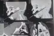 Đũa xuyên qua não, bé gái 1 tuổi thoát chết thần kỳ