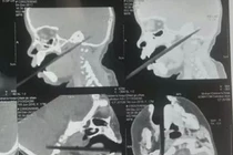 Đũa xuyên qua não, bé gái 1 tuổi thoát chết thần kỳ