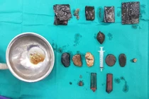 Cứu sống "dị nhân" nuốt dao lam, bác sỹ "mò" được đống đồ trong dạ dày