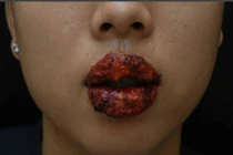 Kinh hoàng cặp môi rỉ mủ, đóng vảy dày cộp sau xăm 