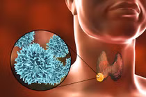 3 người trong gia đình mắc ung thư tuyến giáp không có biểu hiện bệnh