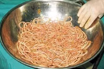 Giun chui lên lỗ mũi qua ống thông dạ dày