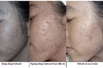 Mụn do mỹ phẩm chứa Corticoid