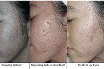 Mụn do mỹ phẩm chứa Corticoid