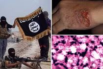 Vi khuẩn “ăn thịt người” có khả năng xóa sổ IS