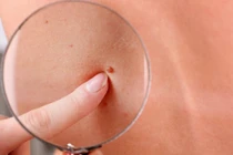 Cuộc cách mạng trong phát hiện sớm ung thư da trên điện thoại 6G 