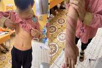 Loạt vụ cha dượng bạo hành con riêng của vợ gây chấn động