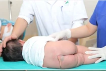 Kỳ tích phẫu thuật cắt đuôi hiếm gặp cho bệnh nhi 5 tháng tuổi