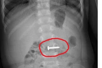 Cứu sống cháu bé ở Quảng Trị nuốt phải cây đinh vít xoắn nhọn