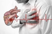 Bác sĩ chỉ rõ triệu chứng điển hình nhồi máu cơ tim cấp