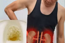 "Nghiền ăn" thứ này, chàng trai khỏe mạnh phải chạy thận ở tuổi 32