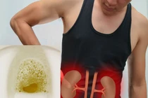 "Nghiền ăn" thứ này, chàng trai khỏe mạnh phải chạy thận ở tuổi 32