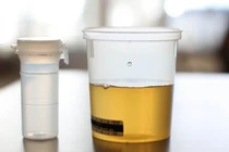 Người đàn ông mắc bệnh lạ, bác sĩ phải lọc... nước tiểu để lấy tinh trùng