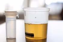 Người đàn ông mắc bệnh lạ, bác sĩ phải lọc... nước tiểu để lấy tinh trùng