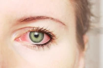 Video: Kinh hãi 11 con giun lúc nhúc trong mắt bé trai 5 tháng tuổi