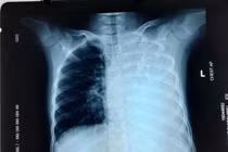 Giành lấy từ tay "tử thần" bé gái bị khối u cực hiếm, thế giới ít thấy