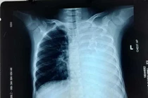 Giành lấy từ tay "tử thần" bé gái bị khối u cực hiếm, thế giới ít thấy