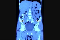 Chụp phim thấy 2 quả thận biến mất, chỉ còn 1… chiếc đĩa!