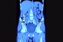 Chụp phim thấy 2 quả thận biến mất, chỉ còn 1… chiếc đĩa!