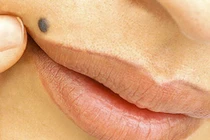 Ngứa nốt ruồi là ung thư?