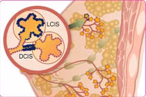 Thuốc mới chữa ung thư vú giai đoạn cuối