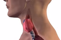 Nguyên nhân gây ung thư tuyến giáp