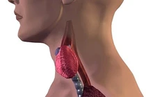 Nguyên nhân gây ung thư tuyến giáp