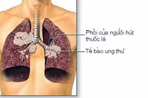 Cần điều trị sớm ung thư phổi