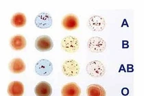 Người nhóm máu nào dễ mắc bệnh ung thư nhất?