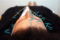 Châm cứu có thể giảm khô miệng sau ung thư